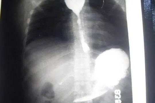 Завершено расследование гибели восьми пациентов петербургской клиники после рентгенографии желудка